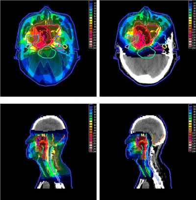 Comparison of dose distributions between IMPT (right) and IMRT (left), fot. By Taheri-Kadkhoda et al. Radiation Oncology 2008 34 doi10.11861748-717X-3-4 [CC BY 2.0